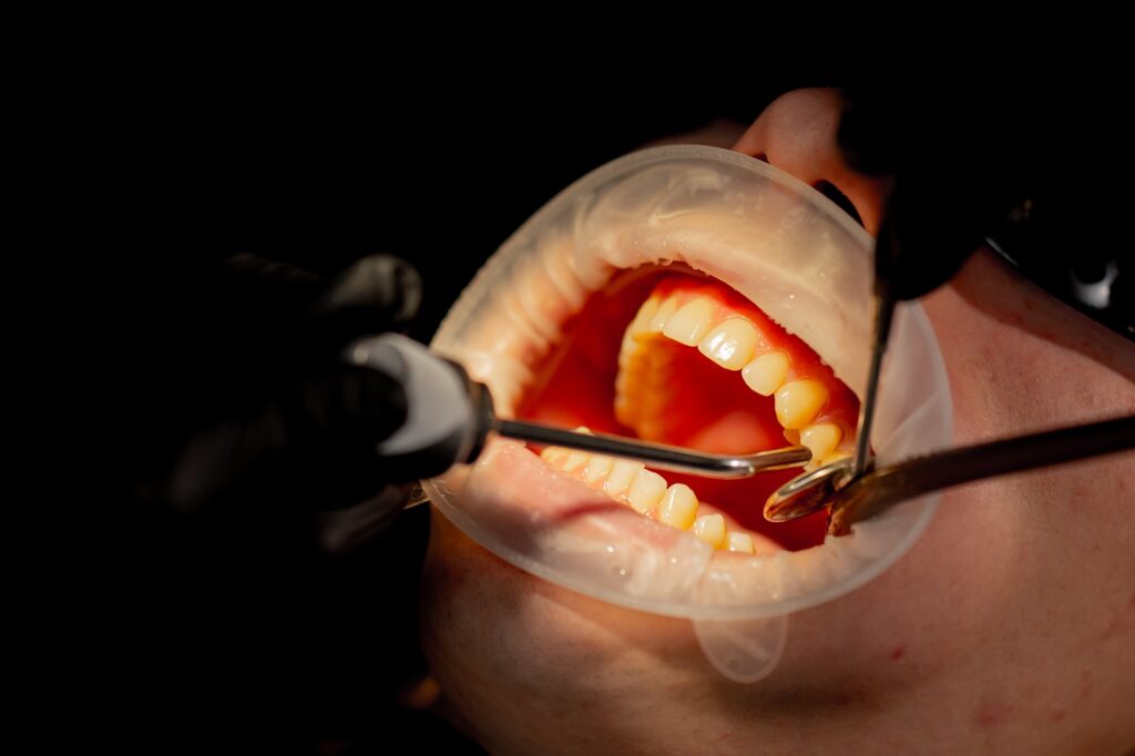 Dental hygienist in Kenmore WA removing tartar buildup during a professional teeth cleaning