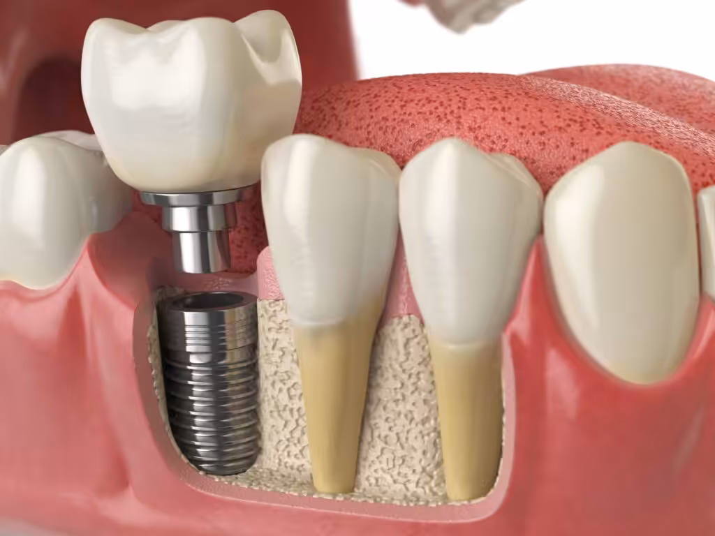 Dentist in Kenmore WA explaining how a dental implant helps preserve jawbone using a dental model