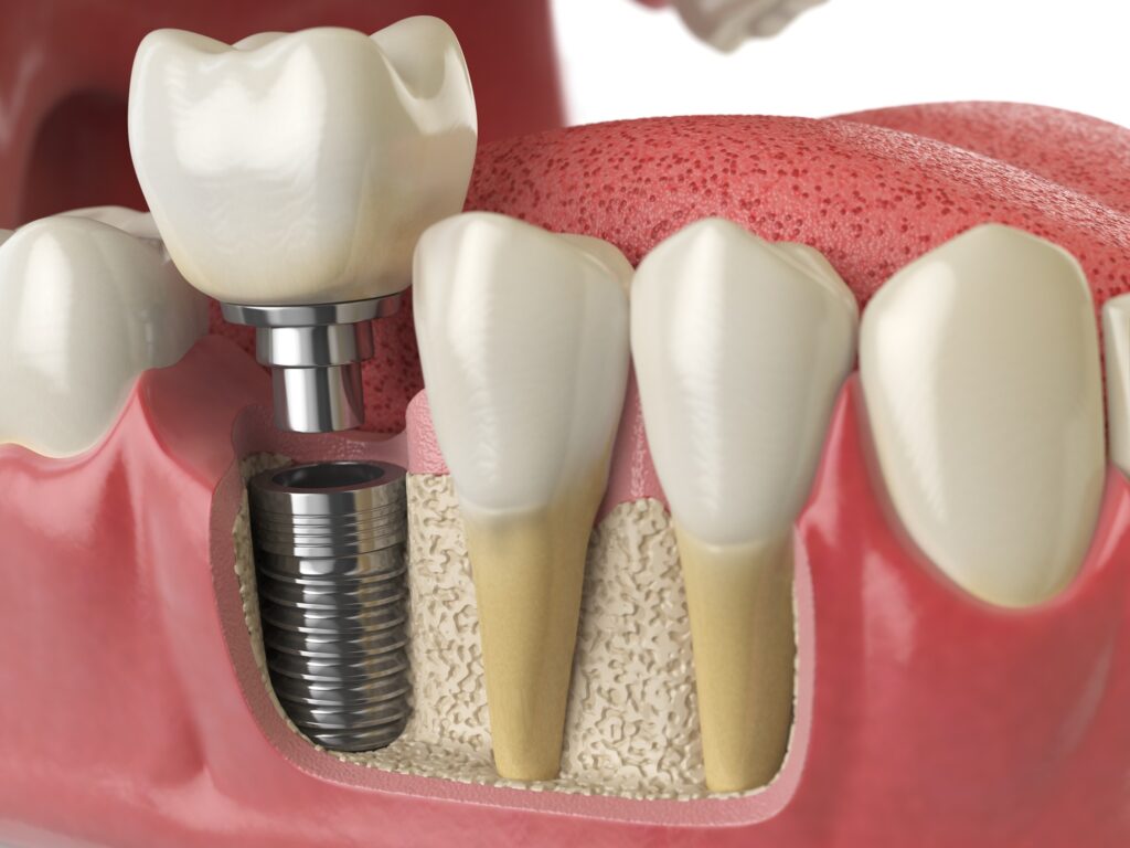 Dentist in Kenmore WA explaining how a dental implant helps preserve jawbone using a dental model